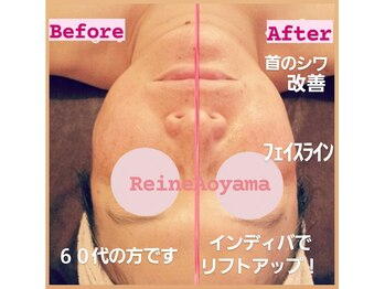 レーヌ青山(Reine Aoyama)/【施術】インディバフェイシャル