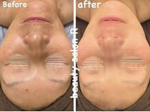 ビューティサロン アール(R)/シミ改善