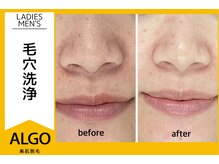 アルゴ 越前店(ALGO)/毛穴洗浄