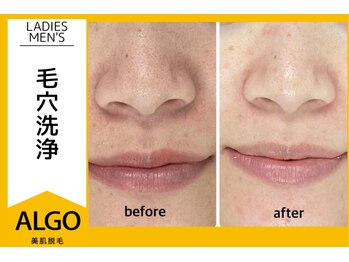 アルゴ 越前店(ALGO)/毛穴洗浄