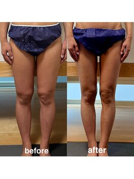 ソラ(sola*)/痩身全身