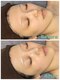 ミミロンビューティー(Mimiron Beauty)の写真/【春限定ペア割】一人が不安ならお二人でどうぞ^^韓国人気No.1ピーリングを一緒に体験してください♪