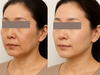 ウェリナベル(WelinaBelle)の写真/大人肌悩みに韓国ピーリングをでハリツヤUP！レモンボトルでやほうれい線・フェースラインをケアします☆