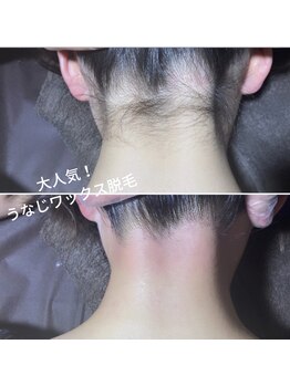 ピークハント(Peak Hunt)/うなじ脱毛
