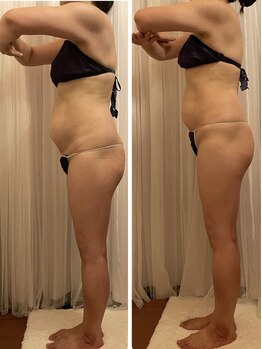 ティアラ/痩身 Before&After