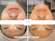 ラヴィオーラ 西宮北口店(La Viora)/ダイヤモンドハーブピーリング