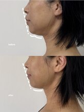 こつこつラボ サンイチマル オオル(310/OOL')/［40代/フェイスライン/たるみ］