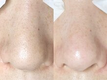 アイラッシュサロン ココ(CoCo)/毛穴エクストラクションプロ