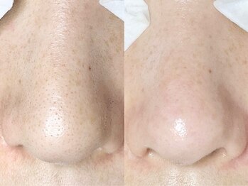 アイラッシュサロン ココ(CoCo)/毛穴エクストラクションプロ