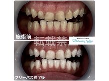 ホワイトニングサロン 福岡天神店/ホワイトニング