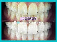 ミルクホワイトニング 長崎中央橋店(Milkホワイトニング)/◆施術例