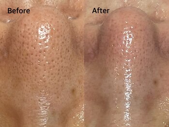 アンベリール みなとみらい店(Embellir)/毛穴洗浄beforeafter