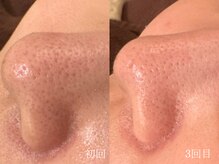 ウォーム(warm)/毛穴/毛穴洗浄/毛穴ケア/毛穴