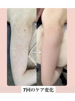 スキンハピネス(skinhappiness)/二の腕ハーブピーリング