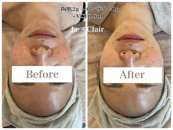 スキンセラピーサロン ル クレール(Le Clair)/Before→After