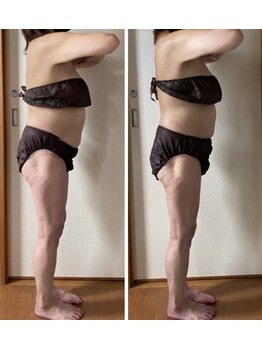 ティアラ/痩身 Before&After