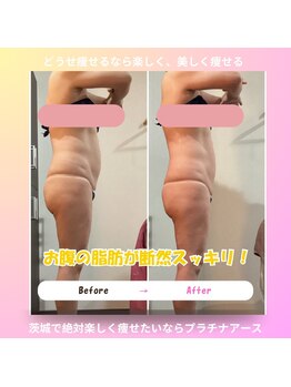 プラチナアース 守谷店(Platinum earth)/痩身ビフォーアフター
