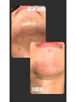 トゥルー(true)/ヒゲ脱毛　経過写真