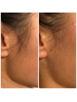 長寿鍼灸院 長寿整骨院/美容鍼50本の効果★エラハリ効果