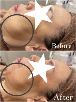 フォルチェ ゆめタウン広島店(Folche)/毛穴/たるみ/小顔/むくみケアに