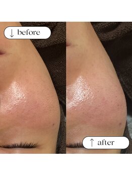 シュシュ(chou.chou)/フェイシャルWax【頬Wax】