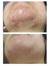 ミーラブ 鹿児島(miilove)/30代ニキビケア