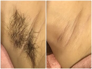 フランベル(Franc bell)/脇脱毛