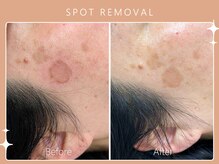 ハノハノ 八代店(HANO HANO)/気になるシミ、何個でもぺろん☆