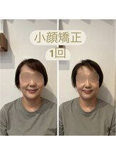 ビボーン ボディ(美bone body)/小顔矯正、月1回のメンテナンス