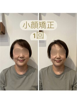 ビボーン ボディ(美bone body)/小顔矯正、月1回のメンテナンス