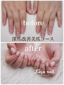 ティアラネイル 宇都宮/深爪改善美爪矯正コース