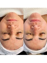 ビューティーザイオン(Beauty zion)/美肌初回施術