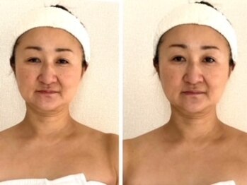 ル シエル(Le Ciel)/50代/一度の施術左before右after