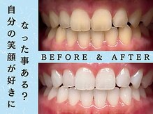 ホワイトニングショップ 浦和店/ホワイトニングビフォーアフター