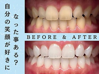 ホワイトニングショップ 浦和店/ホワイトニングビフォーアフター