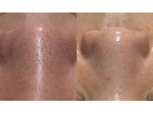 ウィズルーチェ 麻布十番店(with luce)/なかなか隠せない毛穴の汚れ