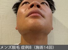 オアシスラグーン(OASIS LAGOON)/メンズ脱毛（症例8 施術14回）