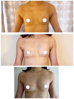 美人バスト 浦和店/【バストアップ★育乳】症例