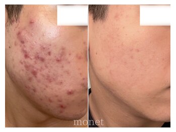 モネ(monet)/【グリーンピール】befoer.after