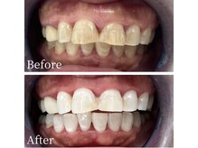 ホワイト 福岡天神店(WHITE)/ホワイトニングビフォーアフター