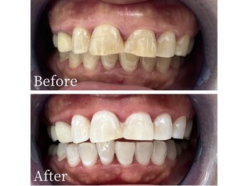 ホワイト 福岡天神店(WHITE)/ホワイトニングビフォーアフター