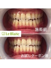 ルブラン 奈良店(Le Blanc)/親子でホワイトニング！