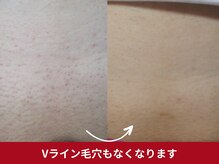 美容脱毛専門サロン エピラージュ 新宿店(Epilage)/vioもツルツル目指せます！