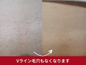 美容脱毛専門サロン エピラージュ 新宿店(Epilage)/vioもツルツル目指せます！