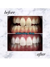 ホワイトニングショップ 岡山店/【岡山】美白ホワイトニング