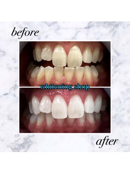 ホワイトニングショップ 岡山店/【岡山】美白ホワイトニング