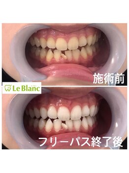 ルブラン 奈良店(Le Blanc)/回数を重ねてムラなく白く