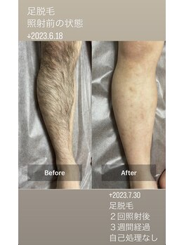 リリー(RILY)/【ビフォーアフター】