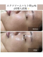 メイリー(MEILI)/ヒト幹細胞50＋エクソソーム導入