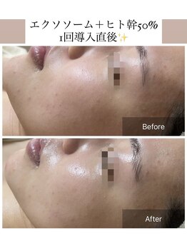 メイリー(MEILI)/ヒト幹細胞50＋エクソソーム導入